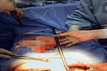 Lâm Đồng: Phẫu thuật thành công, lấy thanh sắt dài 65cm đâm xuyên ngực bệnh nhân